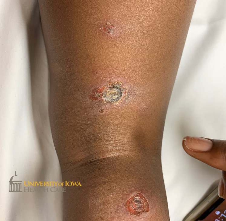Erosions with central crusting and rim of erythema on the lower leg. (click images for higher resolution).